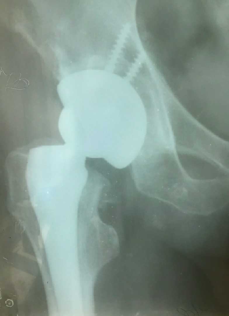 Зображення до публікації: Операція - Суглоб